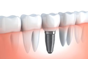 distintos tipos de implantes dentales