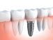 distintos tipos de implantes dentales