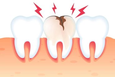 Causas y sintomas de las caries